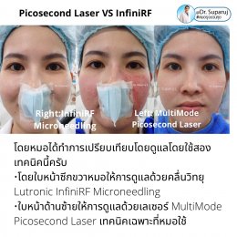 Update ผลการรักษาหลุมสิวด้วย Picosecond Laser VS InfiniRF Microneedle แตกต่างกันอย่างไร อันไหนมีประสิทธิภาพดีกว่า ?