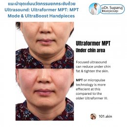 แนะนำนวัตกรรม พลังงานเครื่องเสียง Macro & Micro Focused Ultrasound ยกกระชับผิว Ultraformer MPT: จุดเด่น + ทดสอบลักษณะพลังงาน + การประเมินลักษณะผิว ให้เห็นกันชัดๆเลยครับ