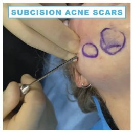 Update เทคนิค Subcision ตัดพังผืดรักษาหลุมสิว Acne Scar Subcision Techniques