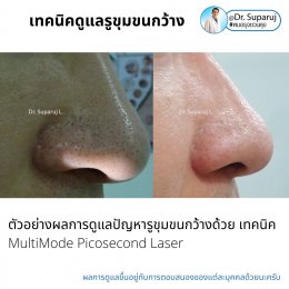 แนะนำเทคนิคดูแลรูขุมขนกว้าง: ตัวอย่างผลการดูแลรูขุมขนกว้าง Enlarged Facial Pore ด้วย MultiMode Picosecond Laser