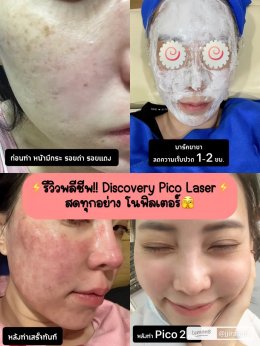 แนะนำเทคนิคดูแลรูขุมขนกว้าง: เทคนิคดูแลรูขุมขนกว้างด้วย Deep Carbon Peel Picosecond Laser (เทคนิคการใช้ Picosecond Laser พิโค่เลเซอร์ ร่วมกับผง carbon กระตุ้นการสร้างคอลลาเจนดูแลรูขุมขนกว้าง )