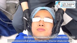 แนะนำเทคนิคยกกระชับผิว ด้วยพลังงานคลื่นเสียง MMFU Focused Ultrasound โปรแกรม Ultraformer MPT