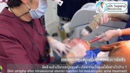 ฉีดสิวแล้วเป็นรอยบุ๋มยุบตัว เกิดจากอะไรดูแลได้อย่างไรบ้าง ?  (Skin atrophy after intralesional steroid injection for nodulocystic acne treatment )