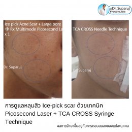  แนะนำเทคนิครักษาหลุมสิวจิกลึก Ice Pick Acne Scar ด้วยเทคนิคเลเซอร์ UltraDeep Pico Technique (Ice Pick Acne Scar Treatment with Discovery Pico Laser + UltraDeep Pico Technique)