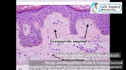  Recap เทคนิคดูแลปัญหาขนคุด & ไลเคนอะไมลอยด์ Keratosis Pilaris (KP) & Lichen Amyloidosis Management