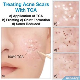 Update เทคนิครักษาหลุมสิว: หลุมสิวแบบจิกลึก Ice Pick Acne Scar มีลักษณะ & ดูแลได้อย่างไร ?