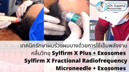 แนะนำ เทคนิครักษาผมร่วงผมบางด้วยการใช้เข็มพลังงานคลื่นวิทยุ Sylfirm X Plus + Exosomes (Sylfirm X Fractional Radiofrequency Microneedle + Exosomes)