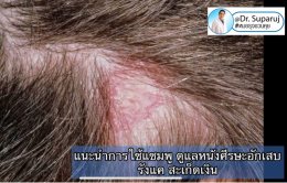 แนะนำเทคนิคการใช้แชมพู ดูแลหนังศีรษะอักเสบ รังแค เซ็บเดิร์ม สะเก็ดเงิน