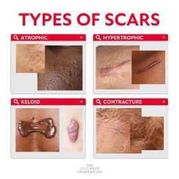 Recap เทคนิครักษาแผลเป็น แผลเป็นนูน คีลอยด์ แผลผ่าตัด Scar Treatment