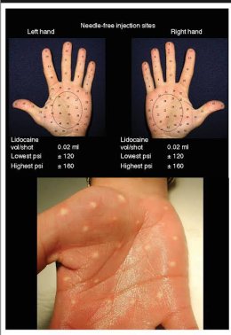 แนะนำเทคนิคดูแลโรคผิวหนัง: ภาวะเหงื่อออกมาก (Hyperhidrosis) คืออะไร & ดูแลได้อย่างไร?