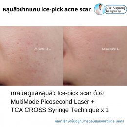  แนะนำเทคนิครักษาหลุมสิวจิกลึก Ice Pick Acne Scar ด้วยเทคนิคเลเซอร์ UltraDeep Pico Technique (Ice Pick Acne Scar Treatment with Discovery Pico Laser + UltraDeep Pico Technique)