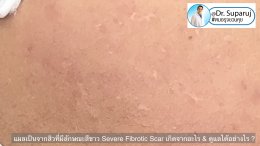 แผลเป็นจากสิวที่มีลักษณะสีขาว severe fibrotic acne scar เกิดจากอะไร & ดูแลได้อย่างไร ?