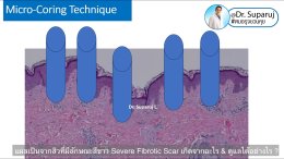 แผลเป็นจากสิวที่มีลักษณะสีขาว severe fibrotic acne scar เกิดจากอะไร & ดูแลได้อย่างไร ?