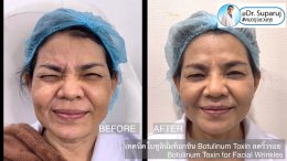 เทคนิคโบทูลินั่มท็อกซิน Botulinum Toxin ลดริ้วรอย Botulinum Toxin for Facial Wrinkles