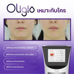 โปรแกรม Oligio ยกกระชับใหม่ ด้วยเทคโนโลยี Monopolar RF พลังงานคลื่นวิทยุ