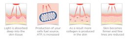 โปรแกรม PORA COOL + Skin Radiant Treatment โพล่าร์คูล + สกินเรเดียน ทรีทเมนท์ หน้ากระจ่างใส ลดการอักเสบของผิว ลดสิว