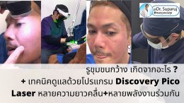 รูขุมขนกว้าง Enlarged Facial Pore เกิดจากอะไร ? + เทคนิคดูแลด้วยโปรแกรม Discovery Pico Laser หลายความยาวคลื่น +หลายพลังงานร่วมกัน