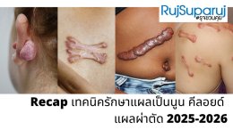 Recap | เทคนิคการรักษาแผลเป็นนูนคีลอยด์ 20252026