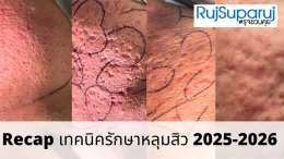 Recap เทคนิครักษาหลุมสิว 2025-2026