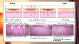 เทคนิคดูแลปัญหาหลุมสิว ด้วย Fractional non ablative 1470 nm Laser: Program LaserME