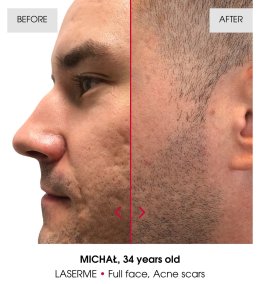 เทคนิคดูแลปัญหาหลุมสิว ด้วย Fractional non ablative 1470 nm Laser: Program LaserME