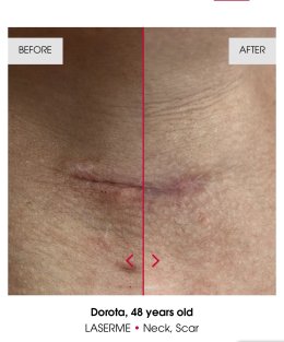 เทคนิคดูแลปัญหาหลุมสิว ด้วย Fractional non ablative 1470 nm Laser: Program LaserME