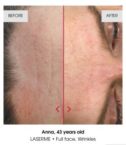 เทคนิคดูแลปัญหาหลุมสิว แผลเป็น รูขุมขนกว้าง ด้วย Fractional non ablative 1470 nm Laser: Program LaserME