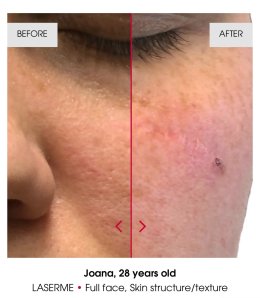 เทคนิคดูแลปัญหาหลุมสิว แผลเป็น รูขุมขนกว้าง ด้วย Fractional non ablative 1470 nm Laser: Program LaserME