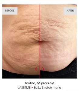 เทคนิคดูแลปัญหาหลุมสิว แผลเป็น รูขุมขนกว้าง ด้วย Fractional non ablative 1470 nm Laser: Program LaserME