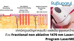 เทคนิคดูแลปัญหาหลุมสิว ด้วย Fractional non ablative 1470 nm Laser: Program LaserME