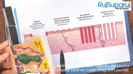 เทคนิคดูแลปัญหาหลุมสิว ด้วย Fractional non ablative 1470 nm Laser: Program LaserME