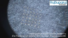 เทคนิคดูแลปัญหาหลุมสิว ด้วย Fractional non ablative 1470 nm Laser: Program LaserME