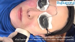 เทคนิคดูแลปัญหาหลุมสิว แผลเป็น รูขุมขนกว้าง ด้วย Fractional non ablative 1470 nm Laser: Program LaserME