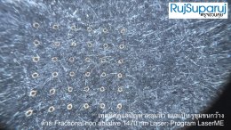 เทคนิคดูแลปัญหาหลุมสิว ด้วย Fractional non ablative 1470 nm Laser: Program LaserME