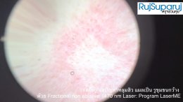 เทคนิคดูแลปัญหาหลุมสิว แผลเป็น รูขุมขนกว้าง ด้วย Fractional non ablative 1470 nm Laser: Program LaserME