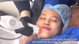 โปรแกรม Oligio แนะนำเทคโนโลยีการยกกระชับใบหน้าด้วย Monopolar RF (Radio Frequency) โดยใช้โปรแกรม Oligio โดยมีประเด็นสำคัญสรุปได้ดังนี้ครับ: