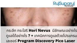 กระโฮริ ปานโฮริ Hori Nevus มีลักษณะ & ดูแลได้อย่างไร? + เทคนิครักษาด้วย โปรแกรม Discovery Pico Laserfor Hori Nevus Treatment
