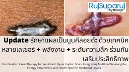 Update รักษาแผลเป็นนูนคีลอยด์: ด้วยเทคนิคหลายเลเซอร์ + พลังงาน + ระดับความลึก ร่วมกันเสริมประสิทธิภาพ Combination Laser Therapy for Keloid and Hypertrophic Scars: Integrating Multiple Wavelengths, Energy Parameters, and Depth-Specific Treatment Levels