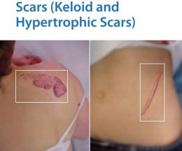รอยแดงในแผลเป็นนูนลอยด์ Keloid Scar Redness เกิดจากอะไร & ดูแลได้อย่างไร ?