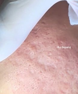 หลุมสิวลึกที่มีพังผืดสีขาว (Fibrosis/ Fibrotic white scar) สาเหตุและการดูแลรักษา