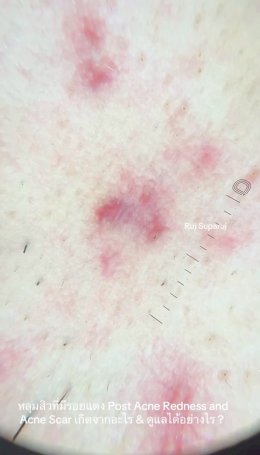 หลุมสิวที่มีรอยแดง Post Acne Redness and Acne Scar เกิดจากอะไร & ดูแลได้อย่างไร ?