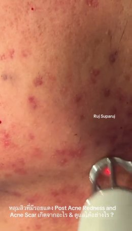 หลุมสิวที่มีรอยแดง Post Acne Redness and Acne Scar เกิดจากอะไร & ดูแลได้อย่างไร ?