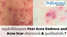 หลุมสิวที่มีรอยแดง Post Acne Redness and Acne Scar เกิดจากอะไร & ดูแลได้อย่างไร ?