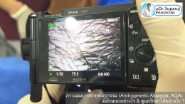 แนวทางการวินิจฉัยและรักษาภาวะผมบางจากพันธุกรรม (Androgenetic Alopecia)