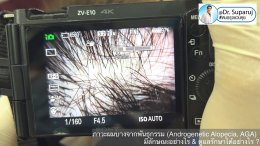 แนวทางการวินิจฉัยและรักษาภาวะผมบางจากพันธุกรรม (Androgenetic Alopecia)