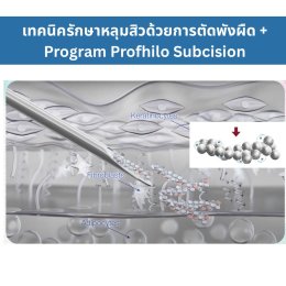 เทคนิครักษาหลุมสิว ด้วยการตัดพังผืดหลุมสิวเทคนิค Program Profhilo Bio-Remodeling Fanning Subcision Techniques for Acne Scar Treatment