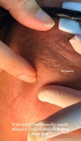 ทำความรู้จักชนิดหลุมสิว: Rolling, Boxcar และ Ice Pick Acne Scar