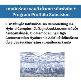 เทคนิครักษาหลุมสิว ด้วยการตัดพังผืดหลุมสิวเทคนิค Program Profhilo Bio-Remodeling Fanning Subcision Techniques for Acne Scar Treatment