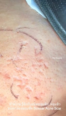 ทำความรู้จักชนิดหลุมสิว: Rolling, Boxcar และ Ice Pick Acne Scar