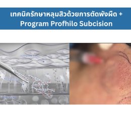 เทคนิครักษาหลุมสิว ด้วยการตัดพังผืดหลุมสิวเทคนิค Program Profhilo Bio-Remodeling Fanning Subcision Techniques for Acne Scar Treatment